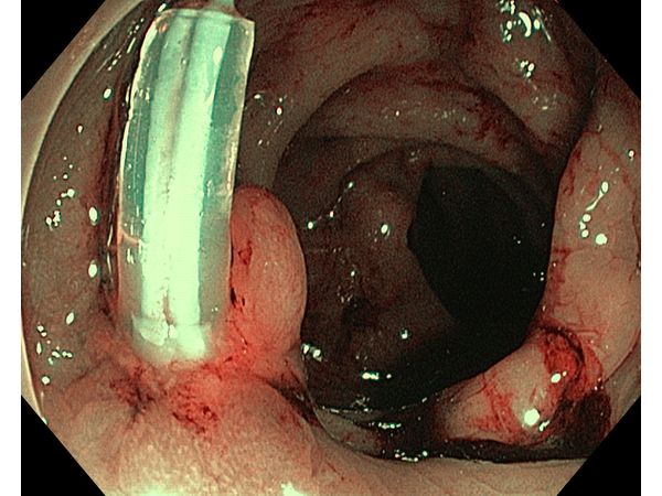 Место удаления