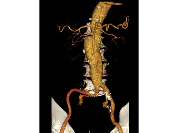 Аневризма брюшной аорты до стентирования