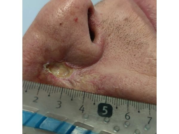 До лечения: дно базалиомы покрыто фибрином