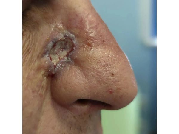 Первые сутки после фотодинамической терапии: формируется геморрагический некроз опухоли