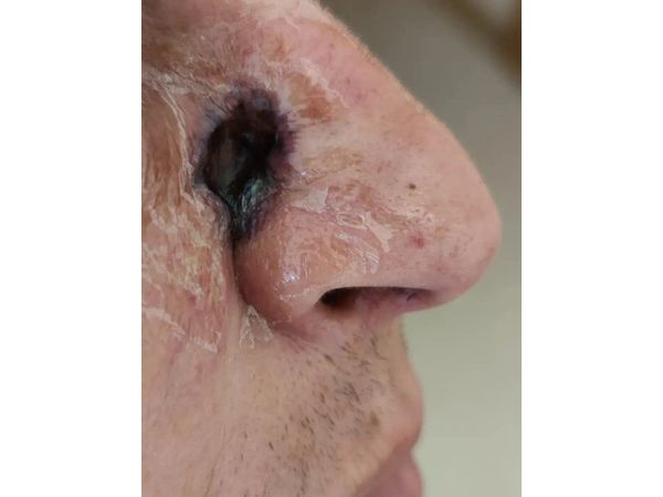 Через четыре дня после лечения: сформированный струп