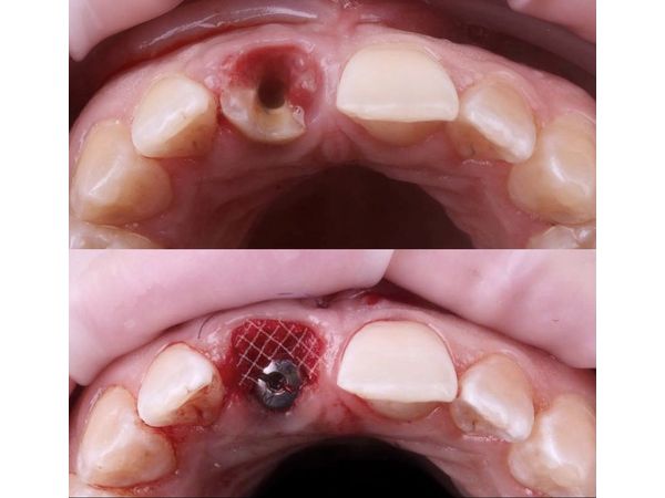 Удаление корня и имплантация Удаление корня и имплантация