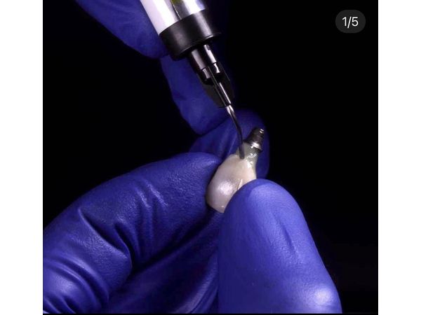 Временная коронка Временная коронка