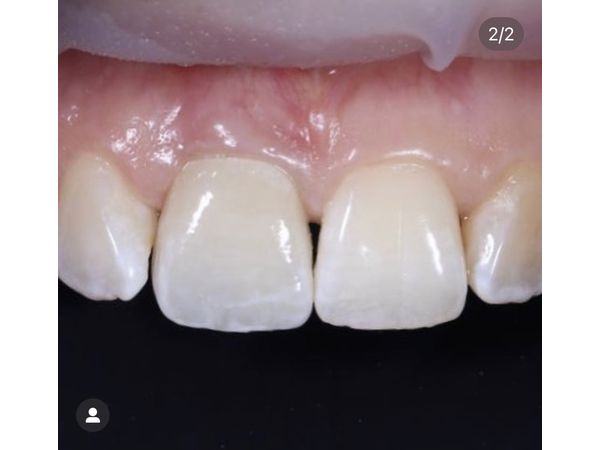 После лечения После лечения