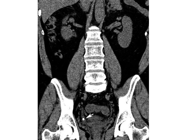 Камень в нижней трети мочеточника фото где расположен