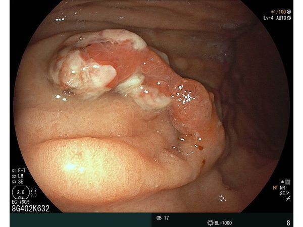 Полип на толстой ножке с изъязвлением на верхушке 