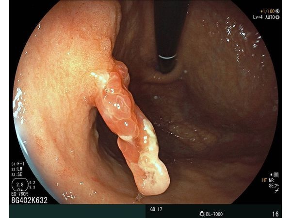 Второй полип на ножке и с изъязвлением 