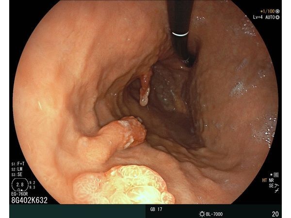 Положение инверсии, видны все три образования 