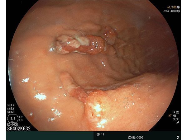 Белый налёт на верхушке (фибрин) 