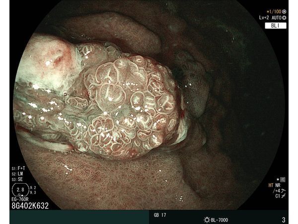 Осмотр в узком спектре света, чётко видим строение образования