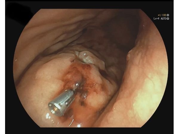 Эндоскопическая картина после удаления полипов 