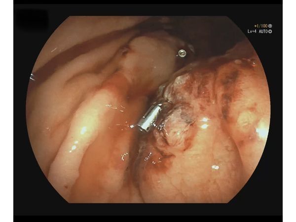 Эндоскопическая картина после удаления полипов