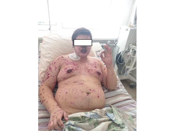 Синдром Стивенса — Джонсона Синдром Стивенса — Джонсона