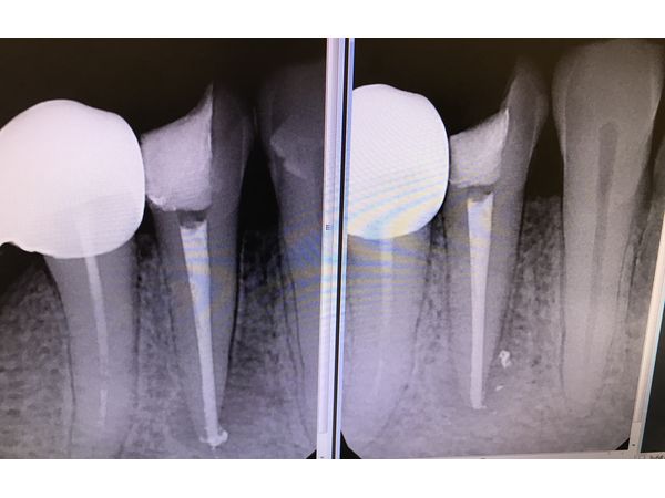До и после пломбирования До и после пломбирования