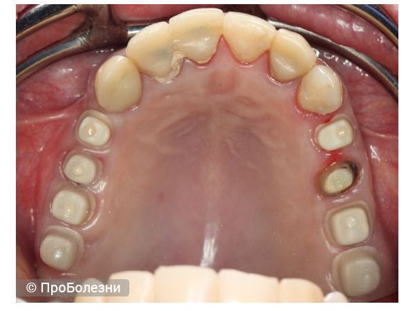 Надкостные элементы протезирования на верхней челюсти