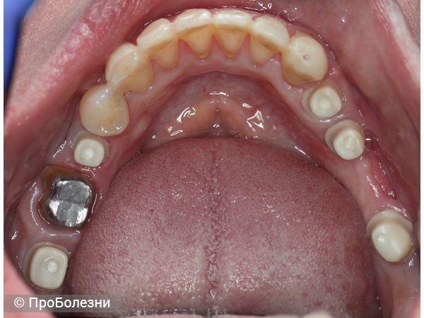 Надкостные элементы протезирования на нижней челюсти