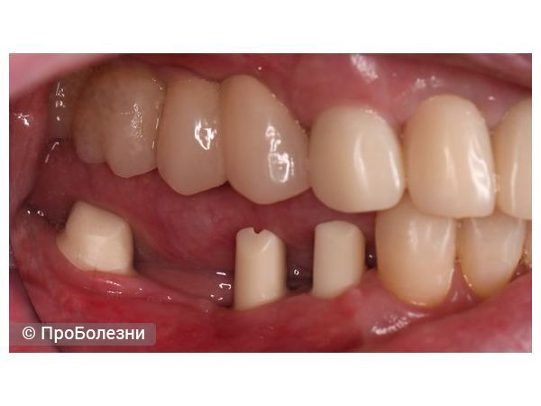 Надкостные элементы протезирования слева