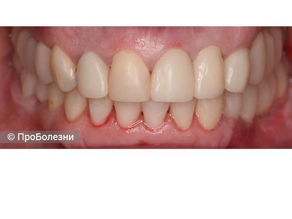 Временные реставрации