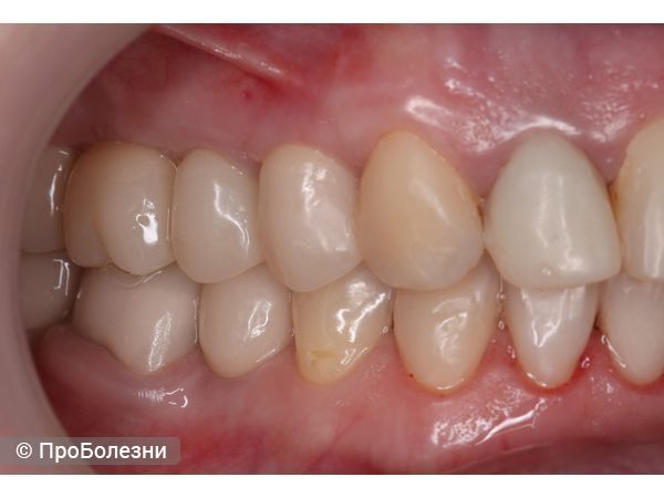 Временные реставрации справа