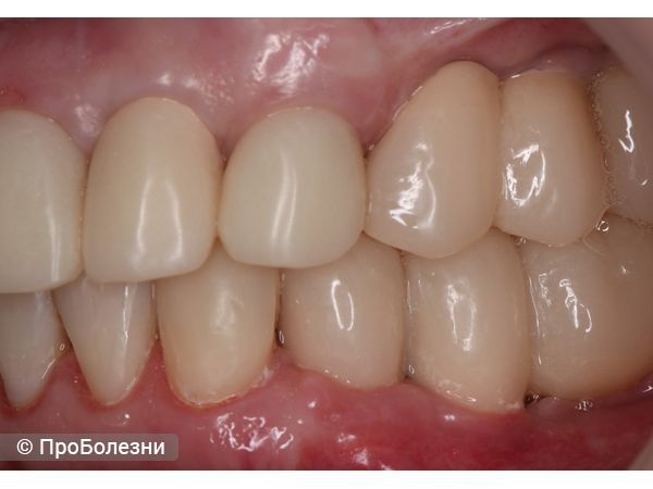 Временные реставрации слева