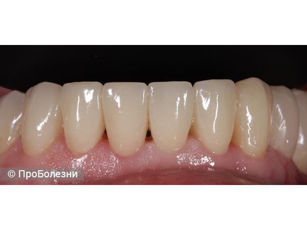 Виниры на нижней челюсти
