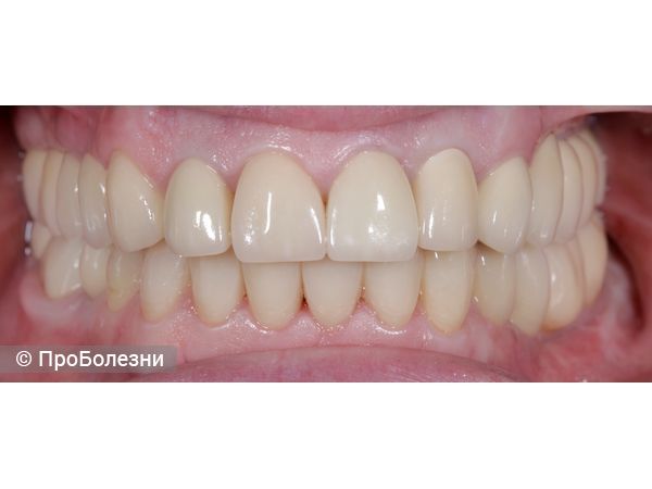 Постоянное протезирование