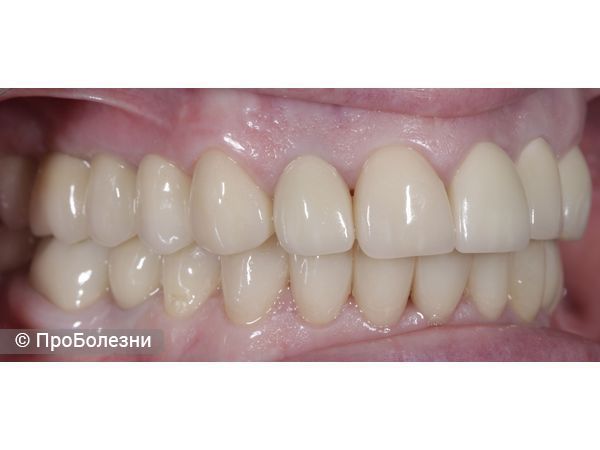 Постоянное протезирование справа.