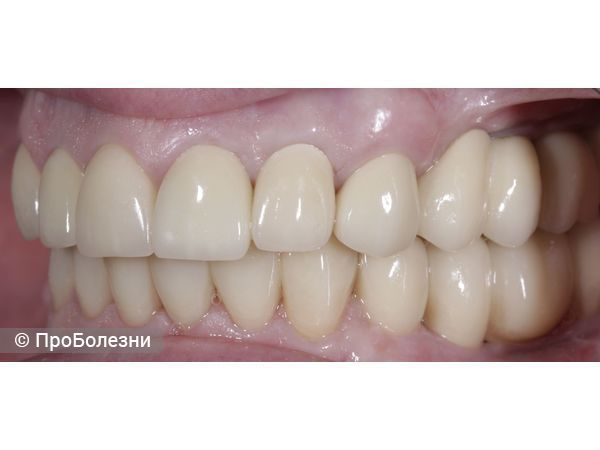 Постоянное протезирование слева.