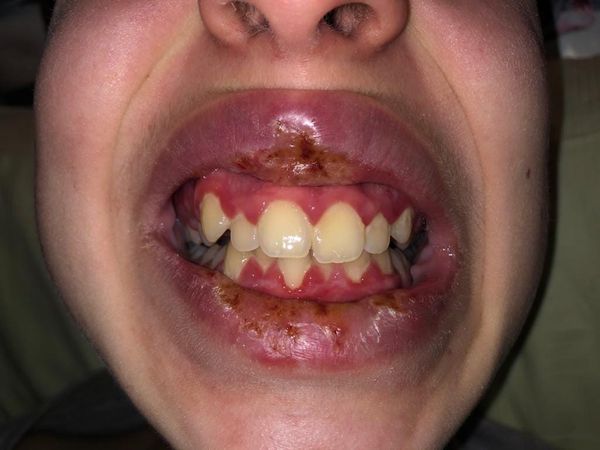 Можно ли лечить зубы при простуде, и в каких случаях