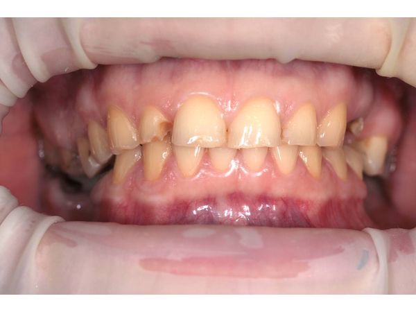 Состояние зубов до лечения