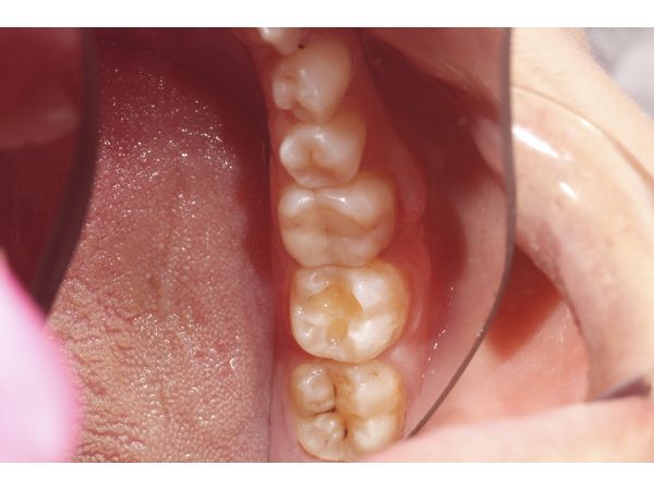 Ротовая полость до лечения