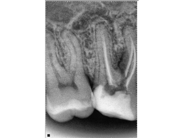 Кальций после распломбировки