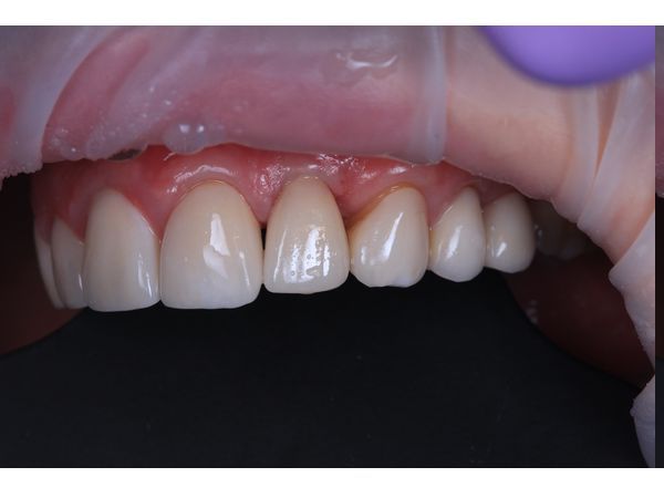 Постоянная коронка через 6 месяцев после лечения