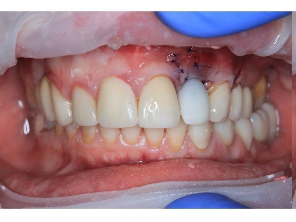 Временная коронка в день имплантации