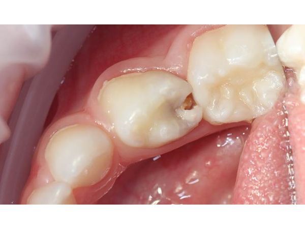 Se puede salvar un diente con periodontitis
