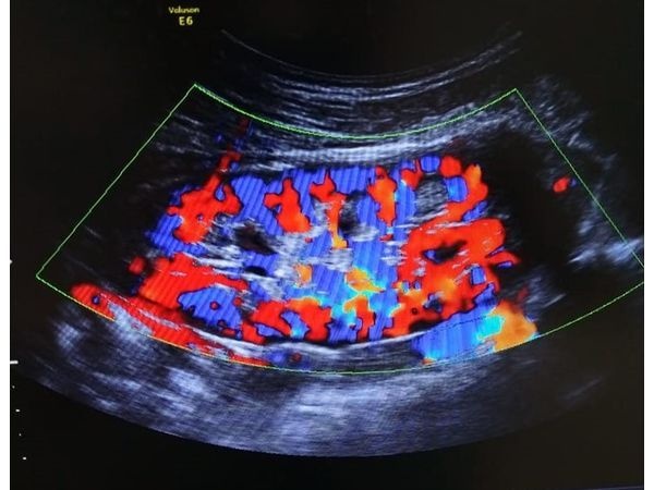 УЗИ почек УЗИ почек