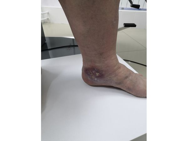 Трофическая язва