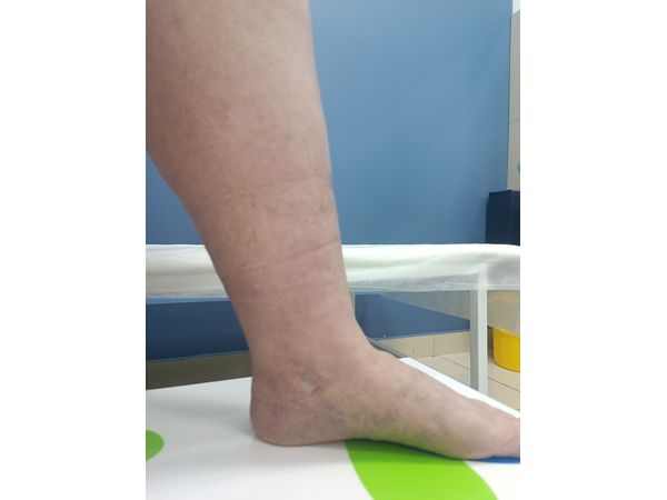 Результат через год после операции