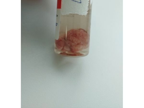 Полип ободочной кишки Полип ободочной кишки