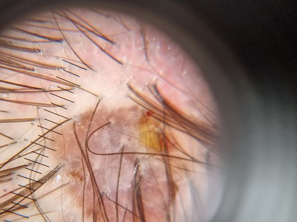 Меланома на коже головы