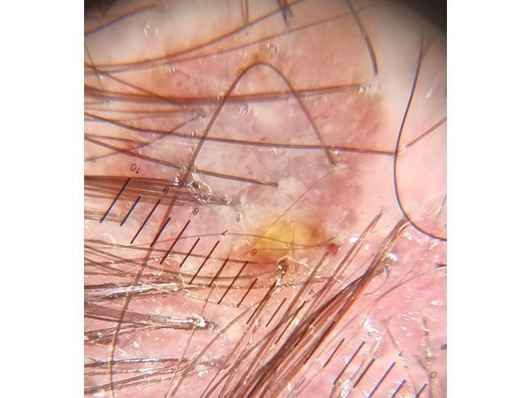 Меланома на коже головы