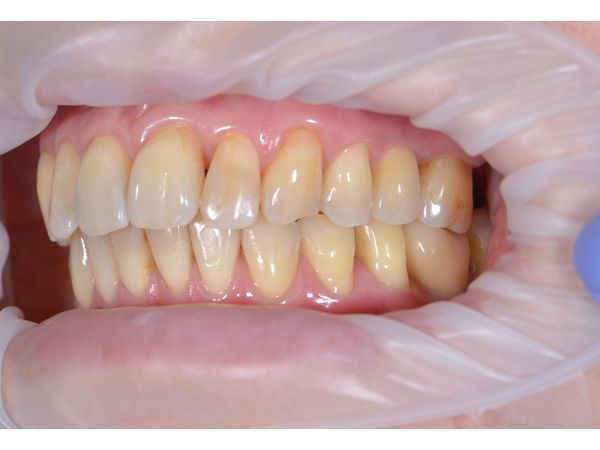 После лечения: установленный имплантат и коронка с винтовой фиксацией