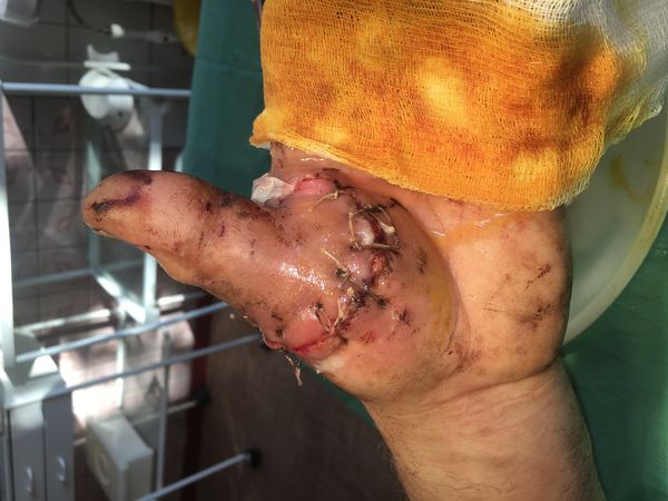 Сразу после операции Сразу после операции