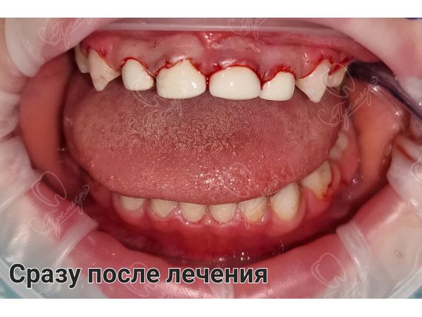 Сразу после лечения