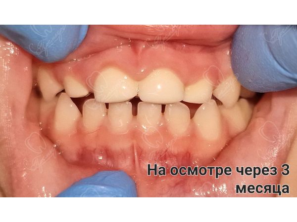 Через 3 месяца после лечения