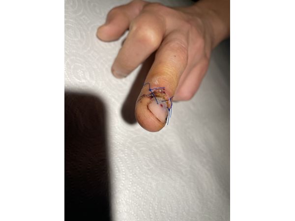 Через неделю после операции