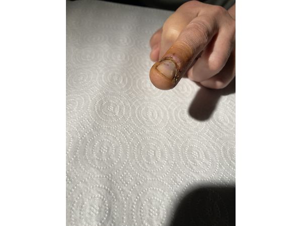 Спустя 12 дней после операции