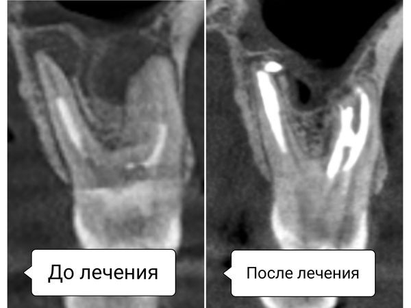 Зуб 2.6 до и после лечения Зуб 2.6 до и после лечения