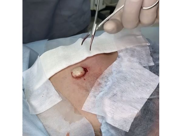 Атерома, капсула не повреждена