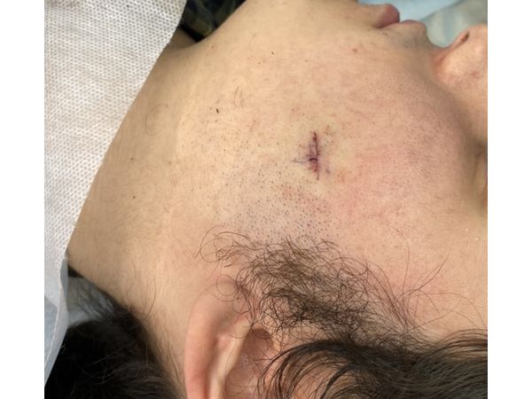 Шов после операции